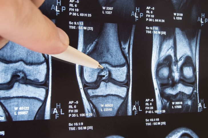 What Happens When Knee Cartilage Is Damaged