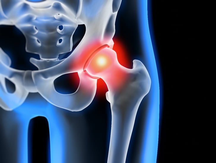 Most Common Causes of Hip Pain and When to Seek Help