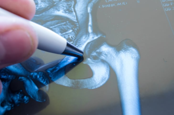 Considering Hip Replacement Surgery? Know Your Other Options!